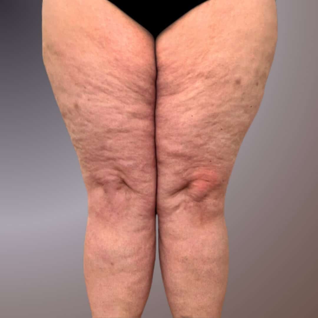 Symptom Lipödem